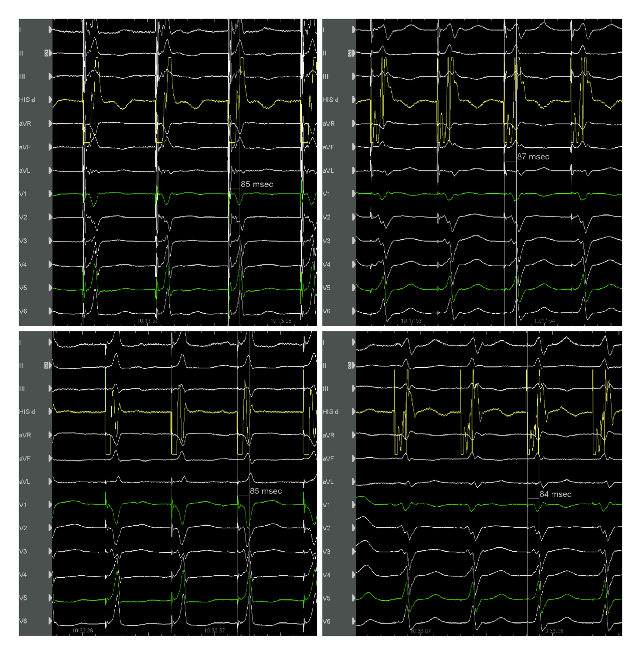 1574740002160096471.png LBBP起搏拼图.png